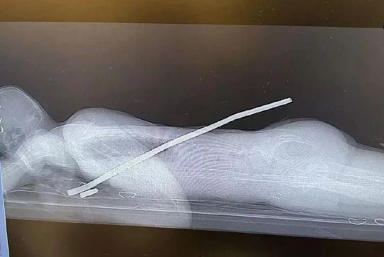 В Сочи врачи спасли мужчину с куском арматуры в грудной клетке