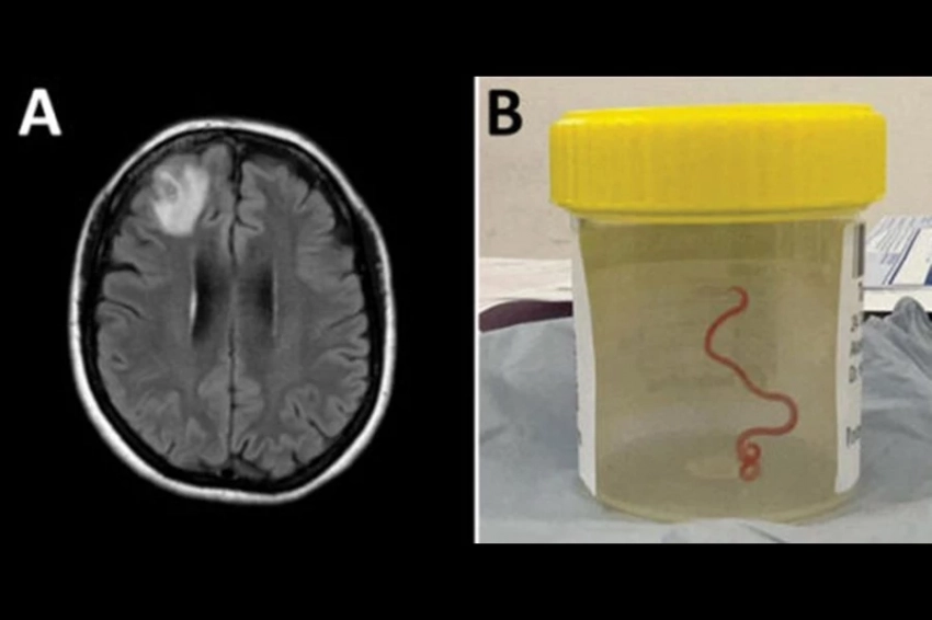 Хирурги впервые вытащили живую аскариду из мозга женщины