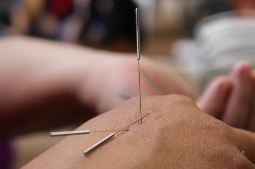 Лечение иглоукалыванием помогает в некоторых случаях