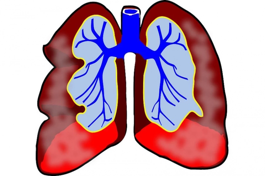 AMA: аппараты искусственной вентиляции легких поражают больных смертельными патогенами
