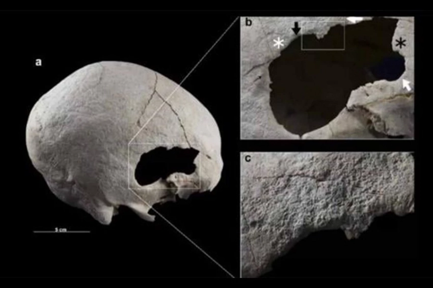 Женщина, жившая в Испании 4500 лет назад, пережила две радикальные операции на голове