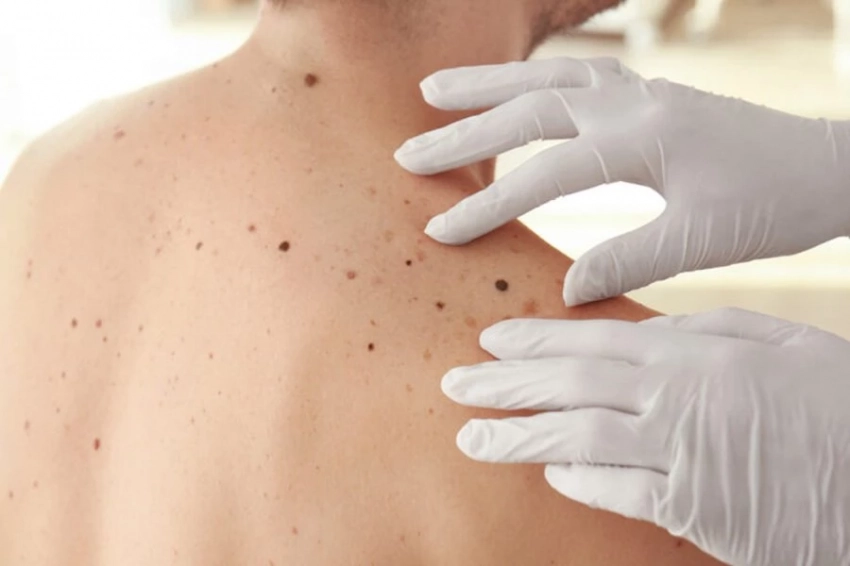 Немеланомный рак кожи смертельнее меланомы