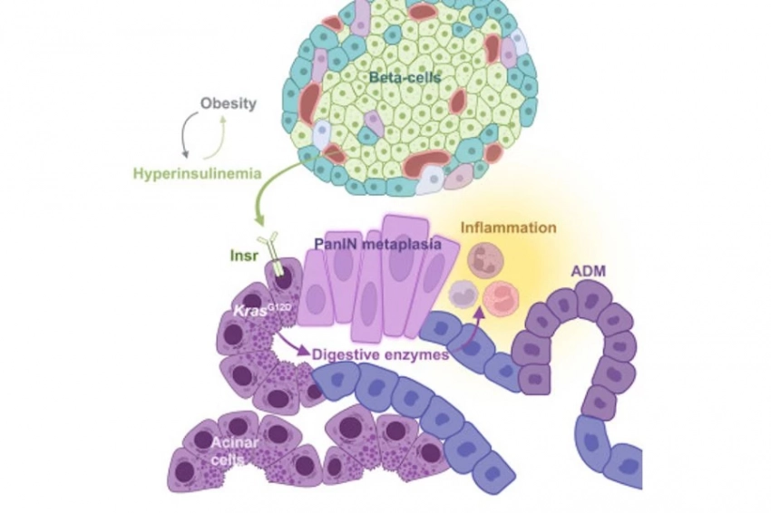 Высокий уровень инсулина напрямую связан с раком поджелудочной железы