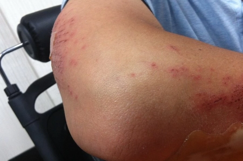 В Перми разработали инновационную противоожоговую мазь из человеческой крови