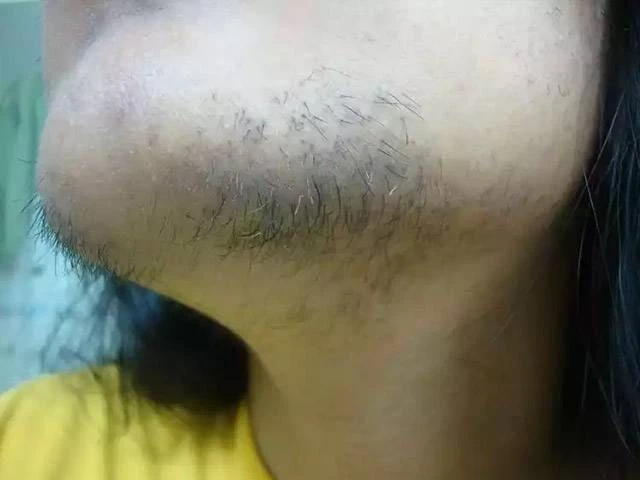 Гирсутизм? Эндокринолог рассказал, когда рост волос на теле и лице является не нормой