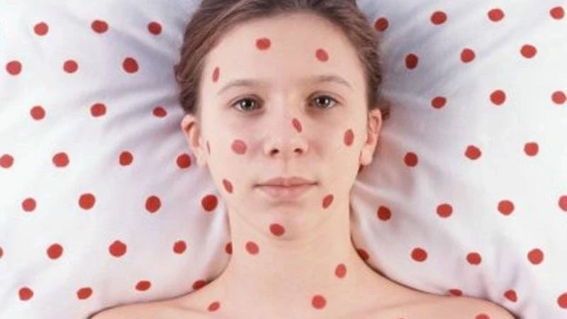 Техас и Нью-Мексико под ударом: в США вспышка кори — есть летальные случаи