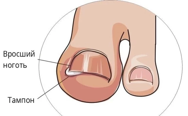 Как победить вросший ноготь и грибок на ногах